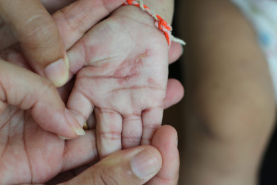 Apa Penyebab Penyakit Kulit Scabies? Ini Penjelasannya